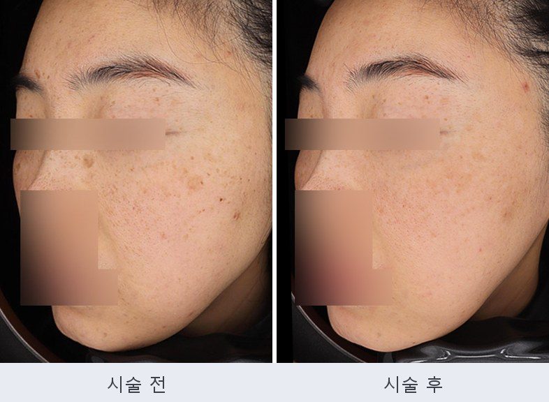 기미 주근깨 흑자